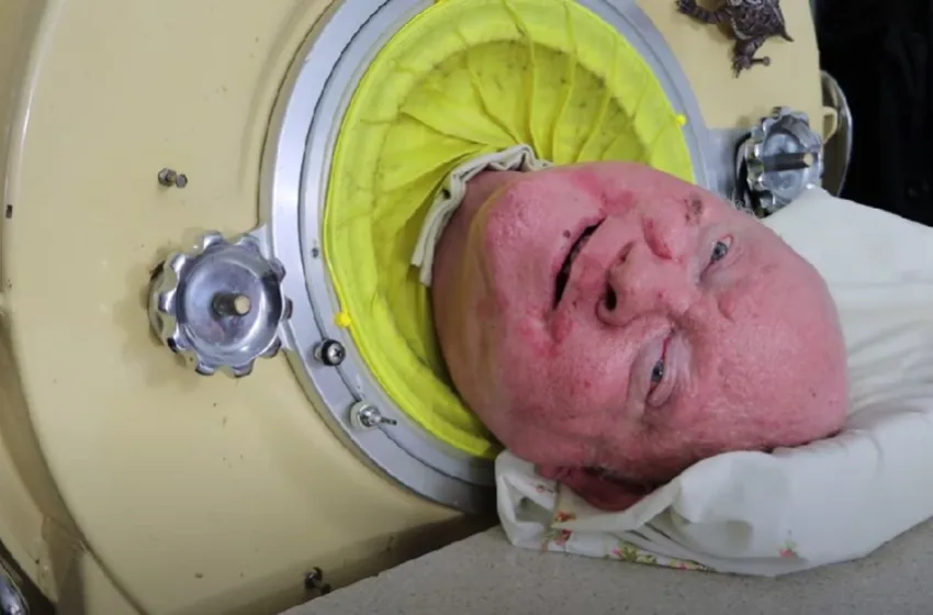  ВИДЕО Почина човекот кој повеќе од 70 години живееше со „железно белодробно крило“